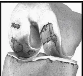 Figura 02: Figura da articulação do joelho com osteoartrose.