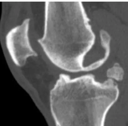 Figura 03 - Imagem radiológica do joelho com osteófitos