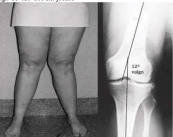 Figura 05 - Deformidade em valgo devido OA em joelho 