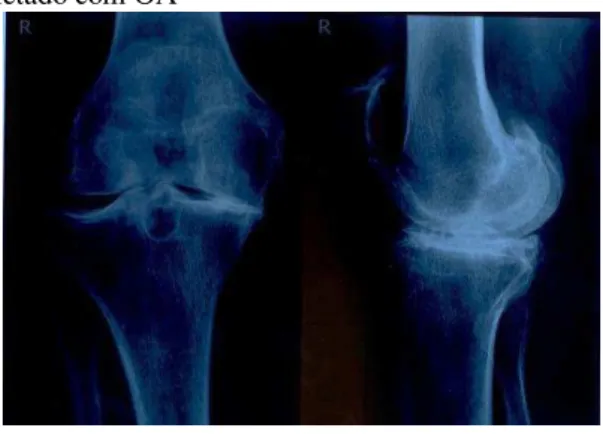 Figura 06 - Radiografia do joelho afetado com OA 