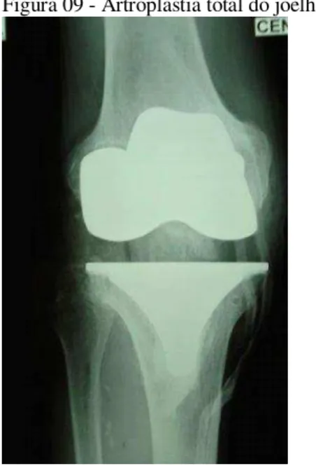Figura 08 - Artroplastia parcial do joelho 