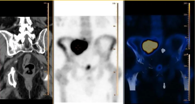 Figura 23 – Aquisição CT adquirida no equipamento PET-CT Gemini (à esquerda) e aquisição SPECT adquirida na Camâra  Gama Brightview (ao centro)