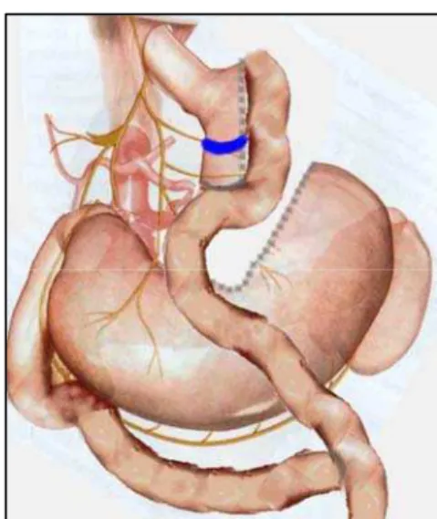 Figura 3 – Gastroplastia em Y-de-Roux. 