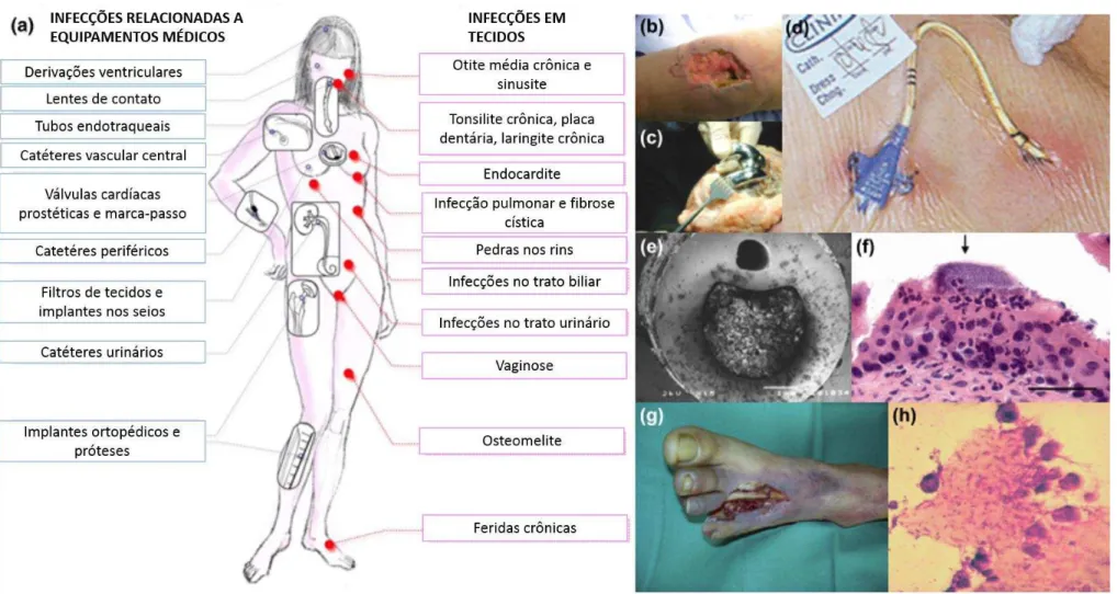 Figura 4 - Biofilmes clinicamente relevantes associados a doenças. (a) Lugares frequentes onde ocorre infecções relacionadas a biofilmes em dispositivos médicos e em tecidos  macios