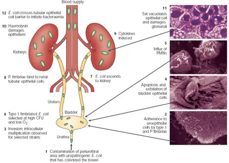 Figura  3  –  Patogénese  da  infecção  do  tracto  urinário  causada  por  E.  coli  uropatogénica