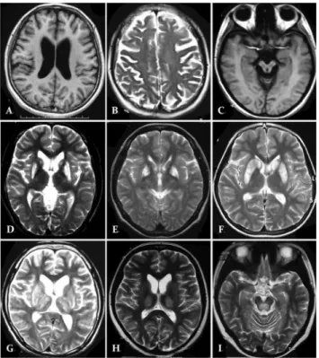 Figure 2. MRI with classically described changes in patients with Wilson’s disease. A