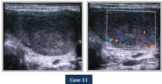 FIG. 2: Microphotography showing Follicular adenoma. 