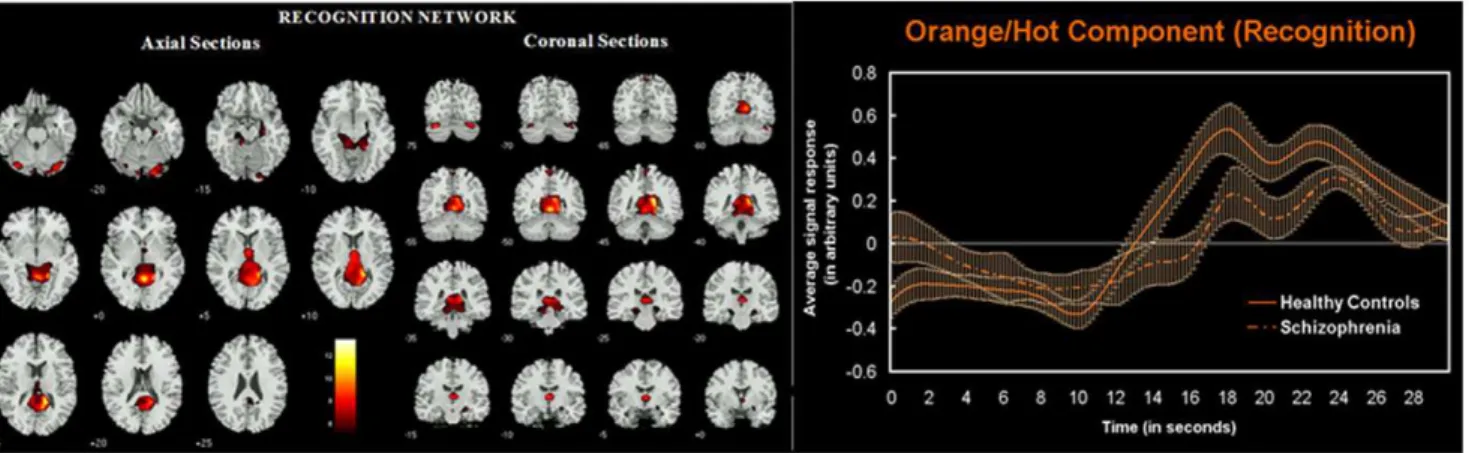 Table 4. Significant regions and their corresponding Talairach coordinates for the network (shown in figure 2) dysfunctional in schizophrenia during working memory probe recognition.