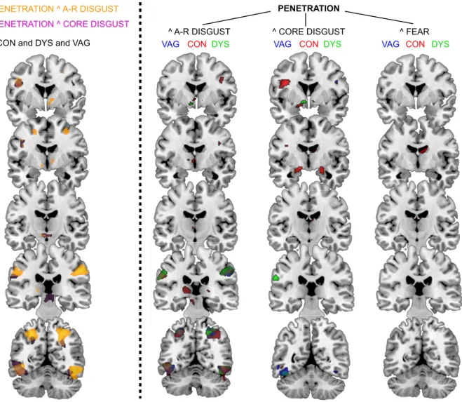 Figure 2. Overlap between PEN and disgust brain activation maps. Overlap between PEN and disgust brain activation maps, resulting from an analysis on the conjugated activity (PEN 
