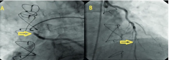 Figure 1. Coronary angiography shows the ostial saphenous graft lesion (A) and LAD lesion (B)