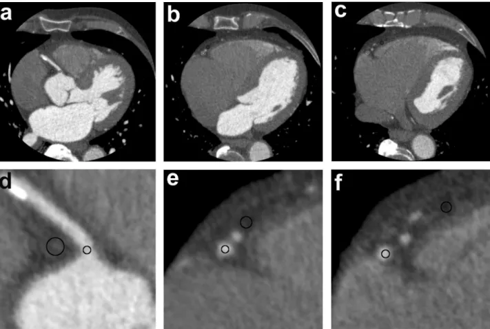 Fig 2. Analysis of signal and noise. Measurement in the vessel and the surrounding tissue at the example of right coronary artery (RCA) being reconstructed by using filtered back projection/ quantum denoising filtering software; axial slices; a/d: proximal