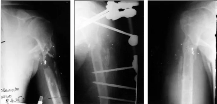 FIGURE 1b. Postoperative radiograph after re - -duction and fixation with external fixator.