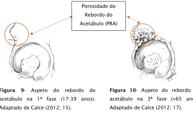 Figura  9-  Aspeto  do  rebordo  do  acetábulo  na  1ª  fase  (17-39  anos). 