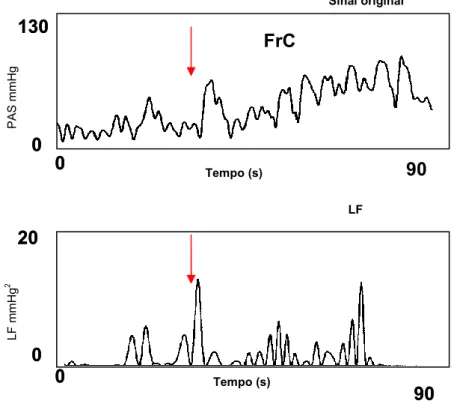 Gráfico 1- Análise wavelet na prova do frio cutâneo. Incremento da PAS durante a imersão da  mão em gelo (seta) acompanhado do aumento da actividade simpática (LF)