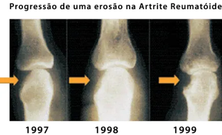 Figura 14. Progressão de uma erosão da AR ao longo dos anos ( NRAS, 2011). 