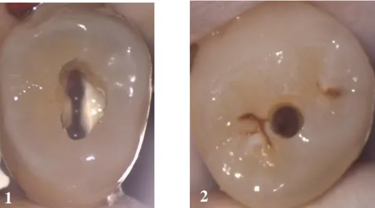 Figura 1 e 2.  Fotografias obtidas através do microscópio ótico de uma abertura coronária tradicional (1) e de  uma abertura coronária minimamente invasiva (2)