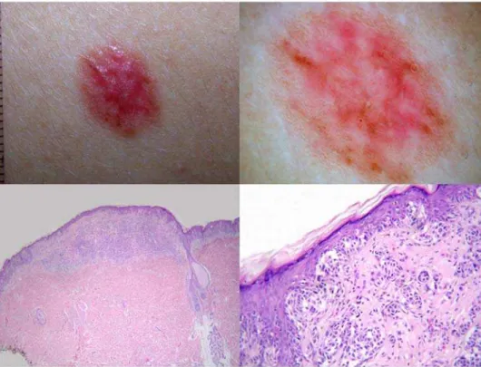 Figure 4. A hypopigmented lesion (top left) from the back in an 18-year-old woman dermoscopically showing atypical vessels and reticular depigmentation (top right)