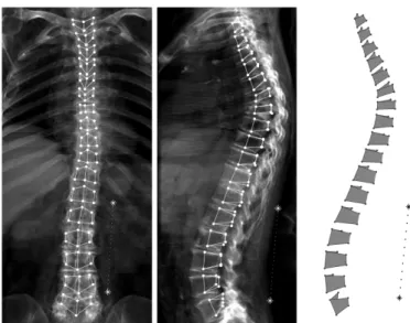 Figure 3: Left – example of digitally reconstructed radiographs (Antero-posterior and Left-right) for the CT scan used on the simulation with the anatomical  land-marks (filled dots) and a representation of the optional calibration object (asterisks).