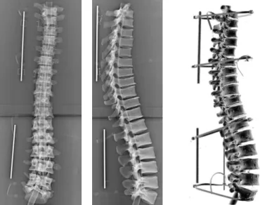 Figure 4: Radiographs of the dried vertebrae with the calibration bar (AP and Lat- Lat-eral), and reconstruction from the CT scan