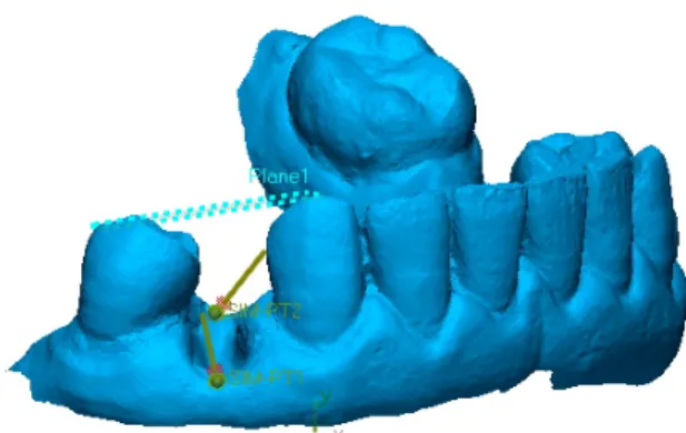 Figura 3: Plano que atravessa a superfície oclusal dos dentes adjacentes 