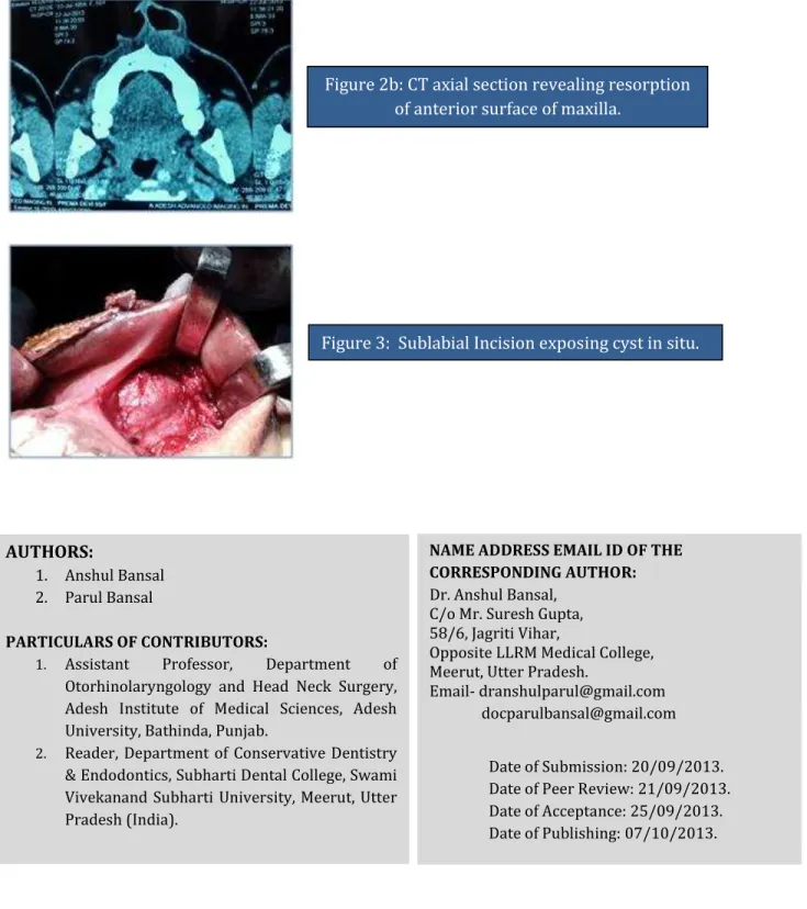 Figure 2b: CT axial section revealing resorption   of anterior surface of maxilla. 