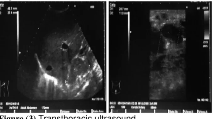 Figure  (4). MR  and PET/CT  images  of  a  39-year-old  woman with lung adenocarcinoma.