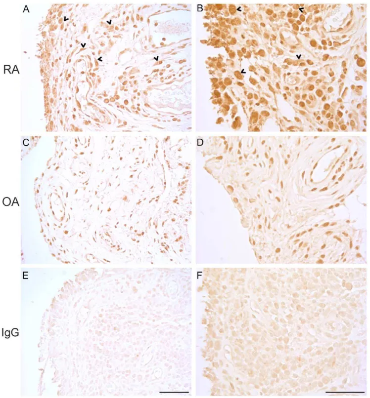 Figure 2. Localization of BMAL1 protein in RA and OA synovium. Tissue sections were incubated in rabbit anti-BMAL1 (anti-MOP3)