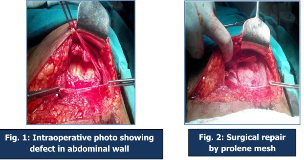 Fig. 1: Intraoperative photo showing  defect in abdominal wall