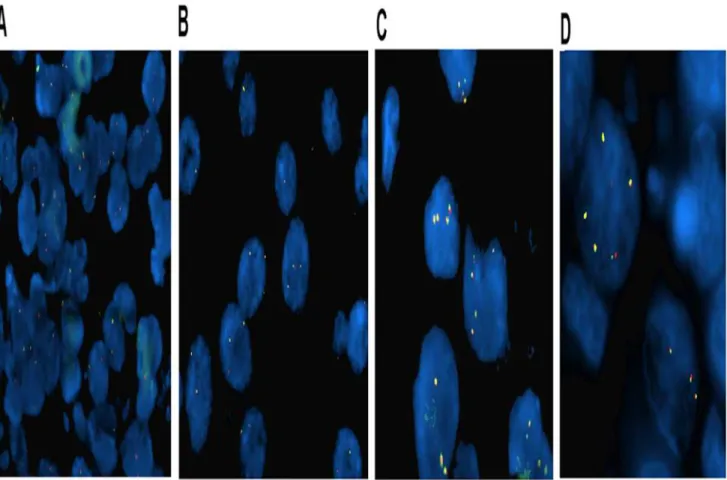Fig 1. Representative ALK fluorescent in situ hybridization (FISH) images in IBC patients