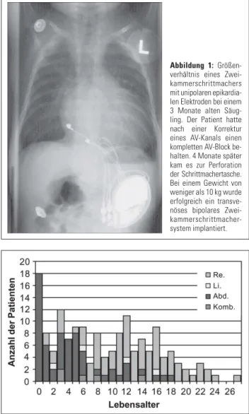 Abbildung 1: Größen- Größen-verhältnis eines  Zwei-kammerschrittmachers mit unipolaren  epikardia-len Elektroden bei einem 3 Monate alten  Säug-ling