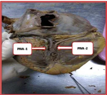 Fig. 1: Shows the posterior inter-ventricular artery  (PIVA) arising from the right coronary artery and  passing down along the posterior inter-ventricular 