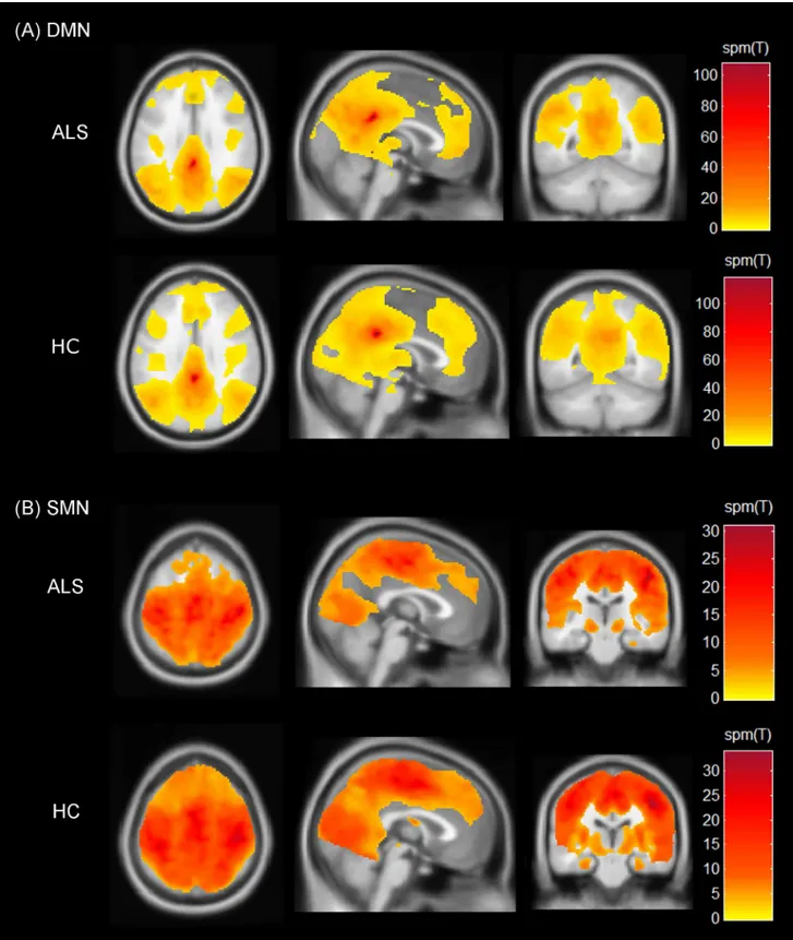 Fig 1. Spatial maps indicating the functional connectivity of the resting state networks