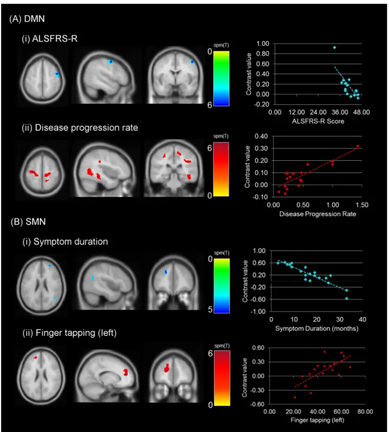 Fig 2. Regional correlations in connectivity with clinical measures. Images represent the correlations observed with the (A) DMN (ALSFRS-R and disease progression rate) and (B) SMN (symptom duration and finger tapping rate)