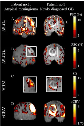 Figure 2. Hemodynamic Response Imaging in patients. HRI results obtained from a patient with atypical meningioma (Left; patient number 1) and from a patient with newly diagnosed glioblastoma (Right; patient number 3); For both patients a representative cor