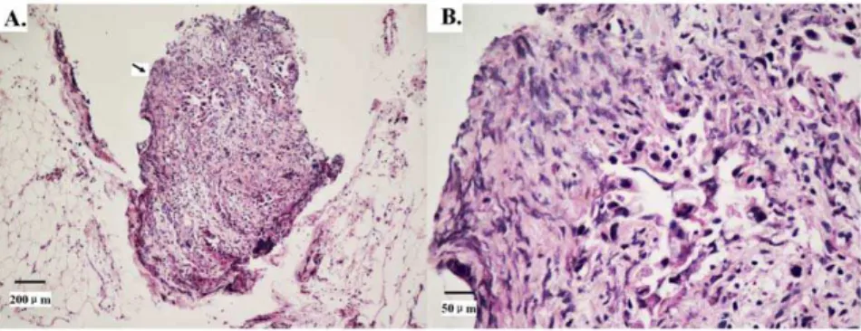 Figure 1. Haematoxylin and eosin staining shows extranodal metastasis (EM) in gastric carcinoma