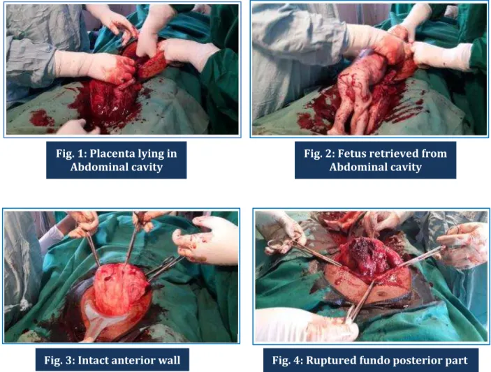 Fig. 1: Placenta lying in  Abdominal cavity 