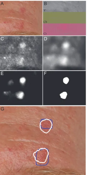 Figure 1. Overview of analysis steps in automated actinic keratosis detection, as applied to the dorsum of hand with the contrast adjusted for visualization