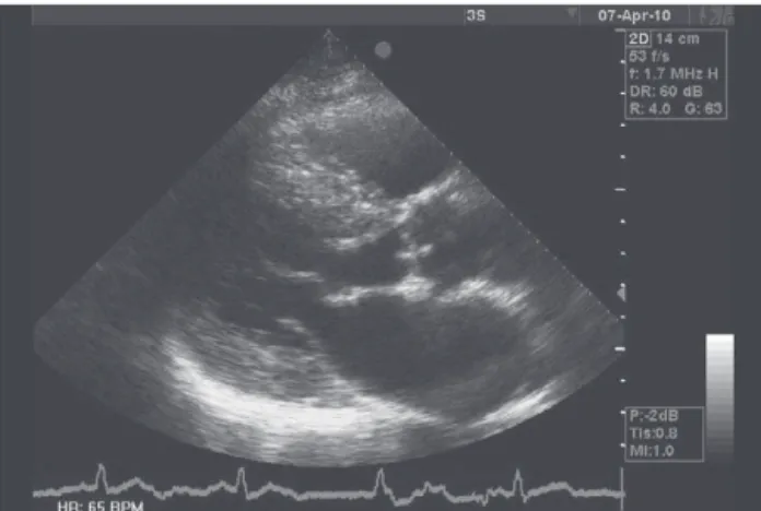 Figure 1. 2D echocardiogram – aortic valve changes