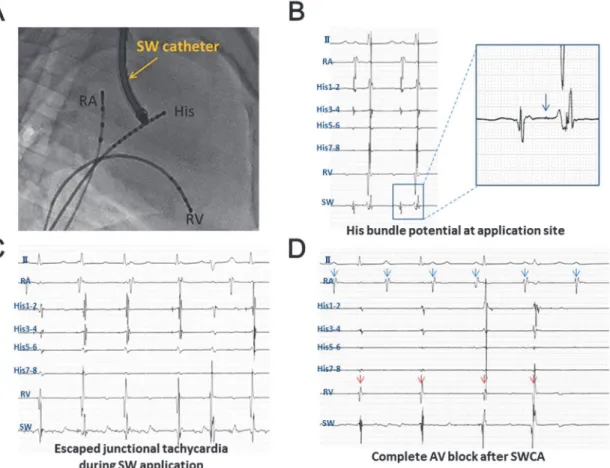 Fig 6. AV Node Ablation by the SWCA System. The SW catheter was inserted through the jugular vein approach (A) and located at the target site where the His-bundle potential (arrow) was recognized (B)