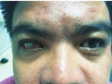 Figure  1.  External  appearance  of  the  patient  showing  the  inflamed  phthisical right eye and inflamed left eye.