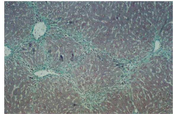 Figure 1. Porto-portal bridging necrosis and diffuse mixed inflammation in the portal area with a fibroblast-like morphology in each section, by week 3, after CCl 4 administration (H&amp;E £ 100).
