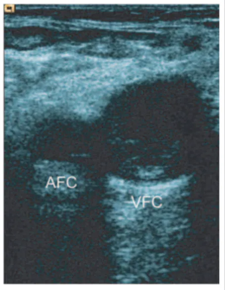 Abbildung 6: Diagnose einer Beinvenenthrombose durch Kompressionssonographie. Thrombose der V