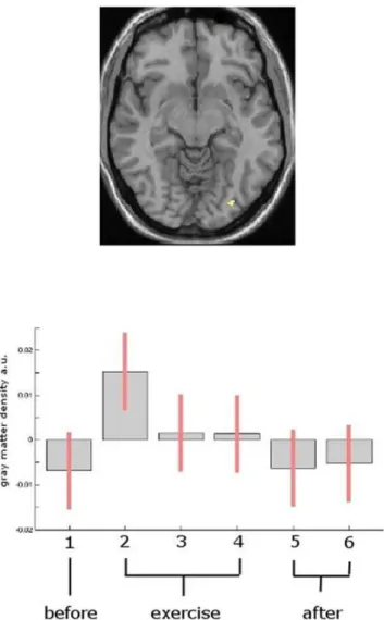 Figure 2. Statistical parametric maps demonstrating structural changes after 7 days. Figure 2 top: Statistical parametric maps demonstrating the transient structural changes after 7 days compared to time point one