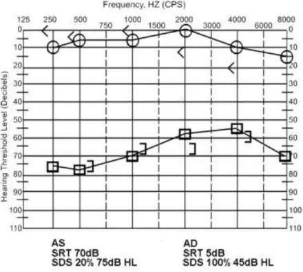 Figura  1.  Audiograma  tonal  simples  de  um  doente  com  surdez  súbita  neurossensorial  idiopática de grau severo no ouvido esquerdo