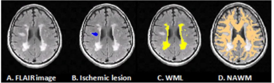 Figure 1. Tissue segmentation example. Subtext: A 60 year old male, scanned two days following stroke onset (A) FLAIR, fluid-attenuated inversion recovery image; (B) Ischemic lesion (blue); (C) WML, white matter lesions (yellow); (D) NAWM, normal appearing