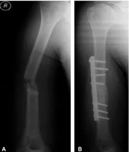 Fig. 1: A. Plain radiograph of right humerus in May 2009. B. Plain radiograph of right humerus in Feb 2010