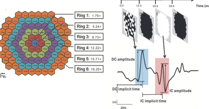 Fig 3. Schematic diagram for grouping the mfERG responses and the waveform of MOFO mfERG