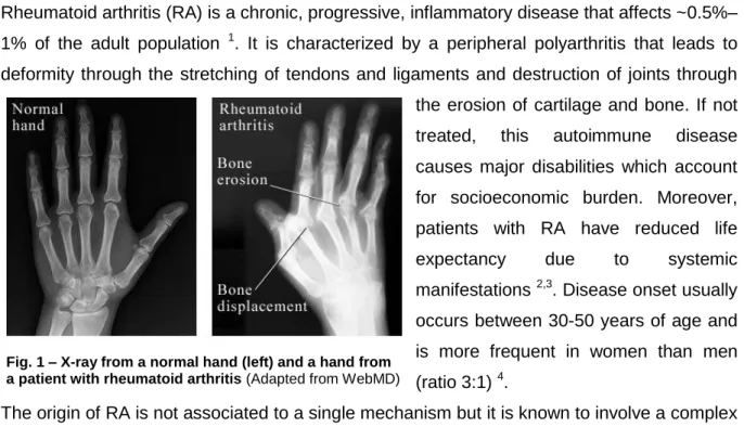 Fig. 1 – X-ray from a normal hand (left) and a hand from  a patient with rheumatoid arthritis (Adapted from WebMD) 
