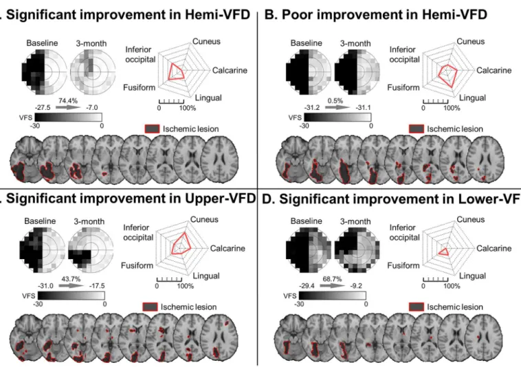 Fig 4. Representative cases of VFD pattern, rEIL and lesion location. (A) Significant improvement in hemi-VFD, (B) Poor improvement in hemi-VFD, (C) Significant improvement in upper-VFD, (D) Significant improvement in lower-VFD