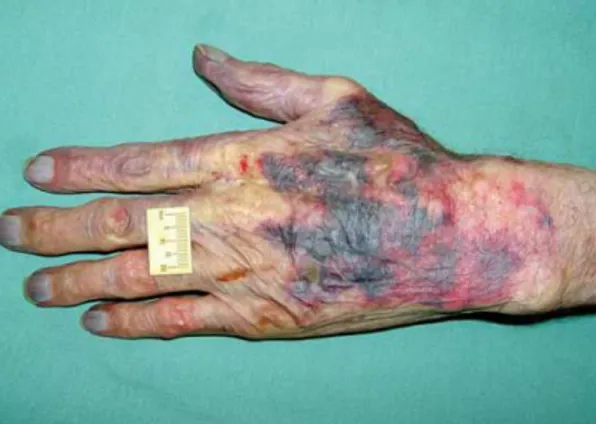 Fig. 3 – Exemplo de uma “Púrpura Senil” na mão esquerda de um  idoso. 